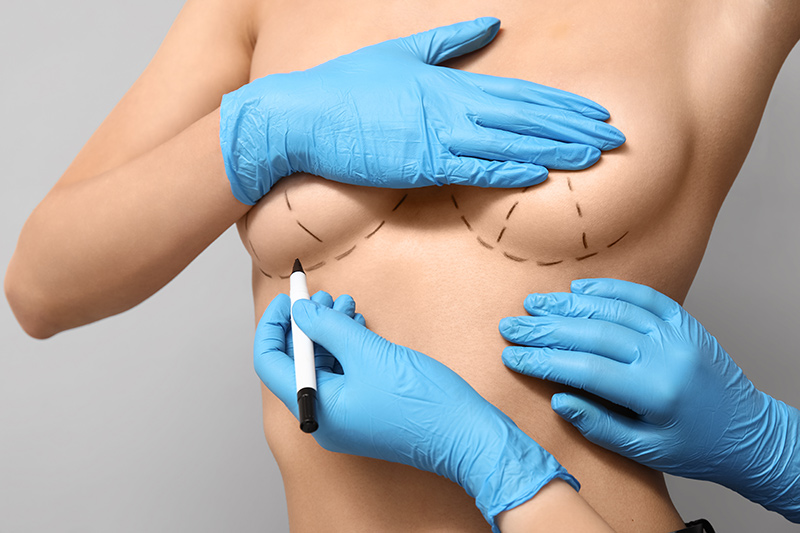How Do Weight Changes Affect Breast Lift Results?