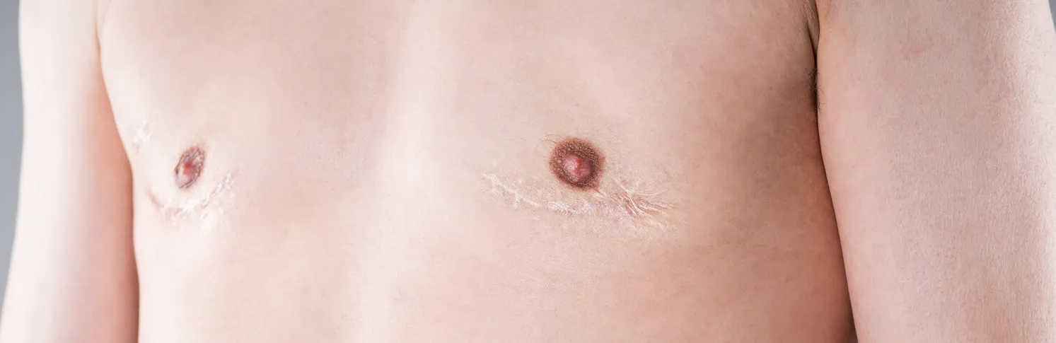 Male torso with surgical scars after gynecomastia