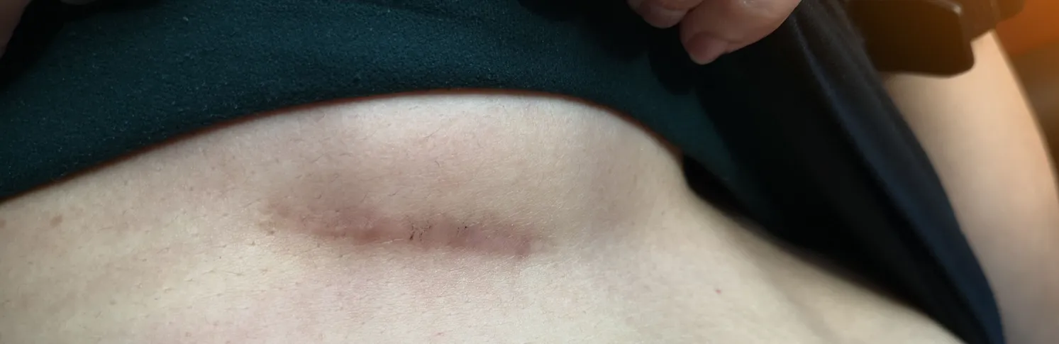 Patient with insertion scar after a breast implant
