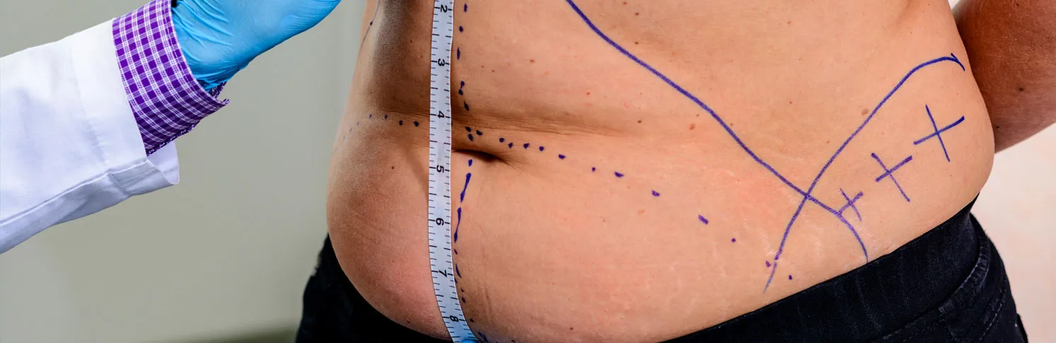 Close-up of a patient being assessed before liposuction