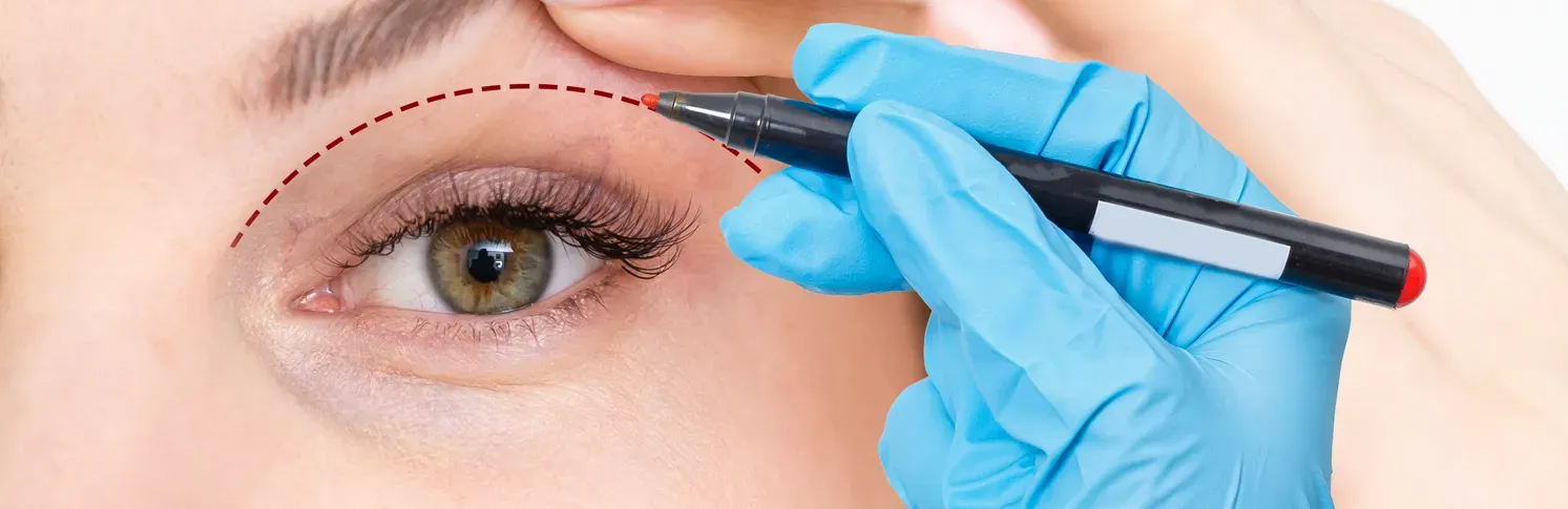 Droopy eyelid surgeon marks the drooping eyelid of a female patient for a surgical operation.